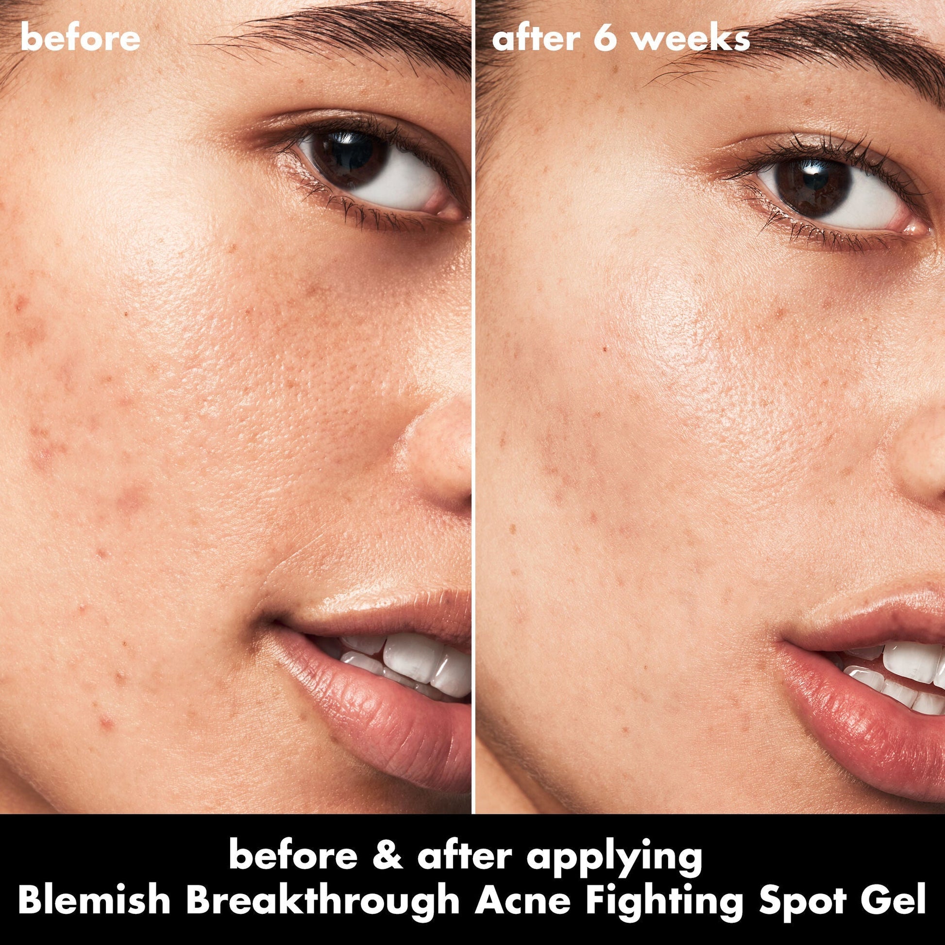 blemish-breakthrough-acne-fighting-spot-gel-v5 0326_EDU_BB_SpotGel_BA_ISABELLA.jpg
