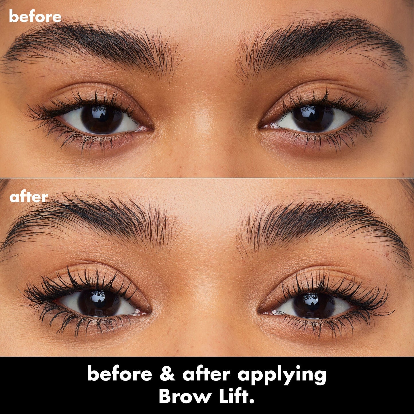 brow-lift-z2 0326_EDU_BrowLift_BA.jpg