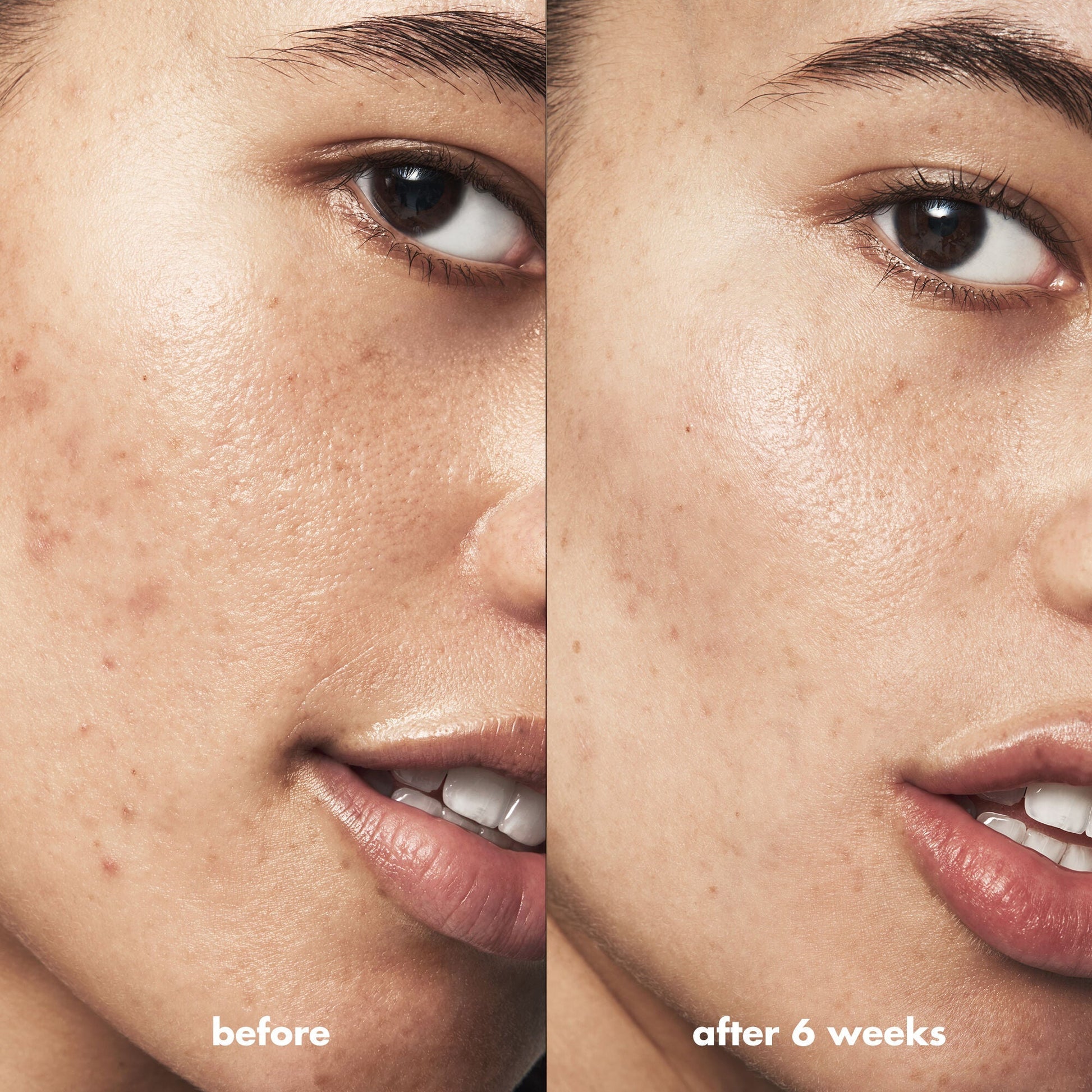 Before and After  Results of Using Blemish Breakthrough Acne Clarifying Cleanser for 6 Weeks