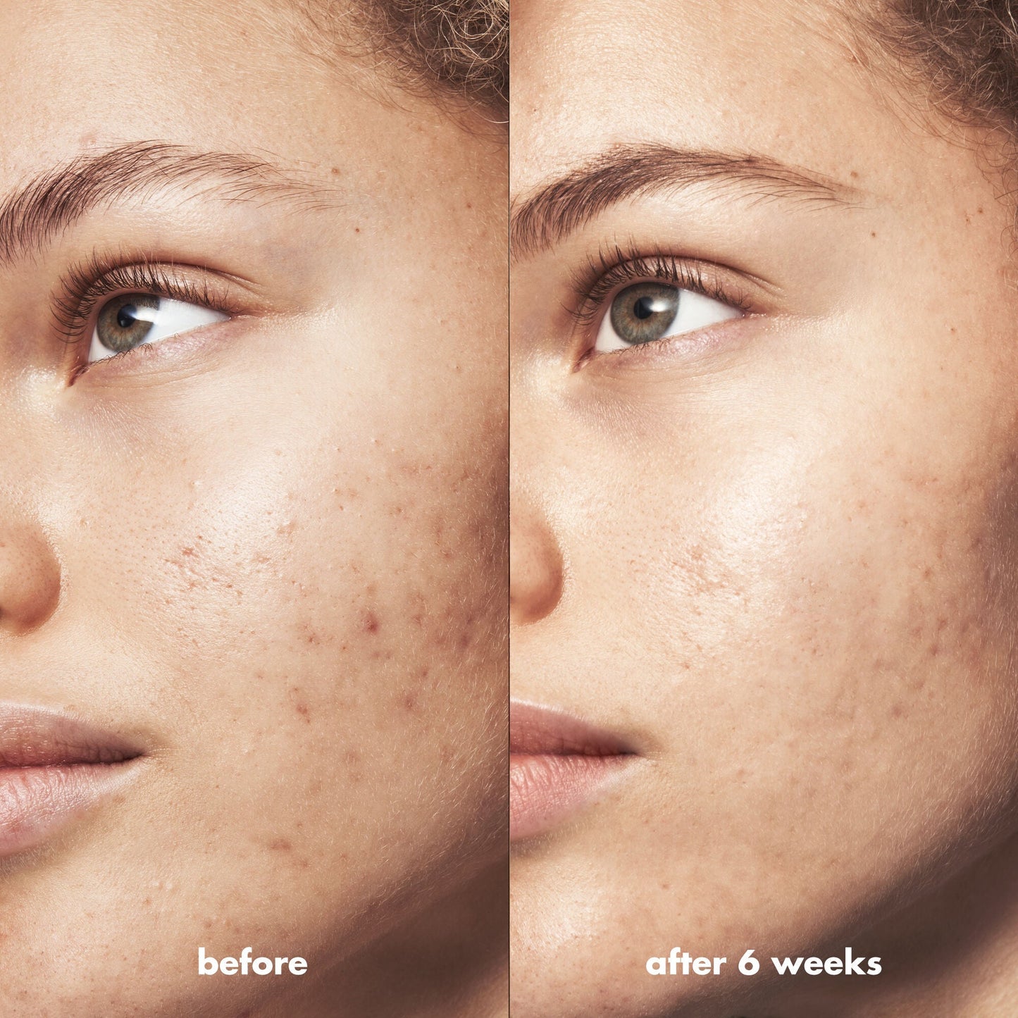 Before and After  Results of Using Blemish Breakthrough Acne Clarifying Cleanser for 6 Weeks
